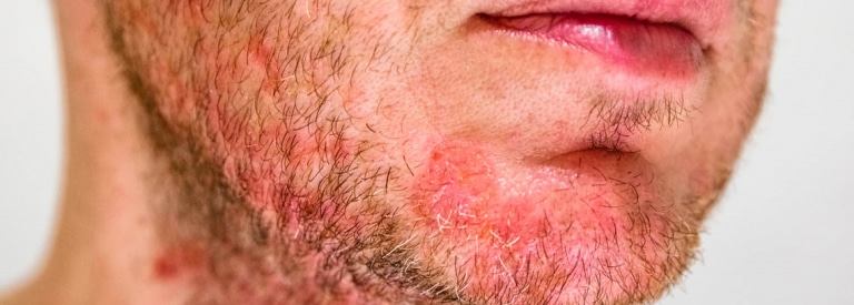 Dermatitis seborreica cómo tratarla canalSALUD