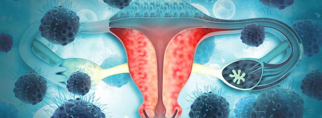 Cáncer de útero se cura Síntomas y tratamientos canalSALUD