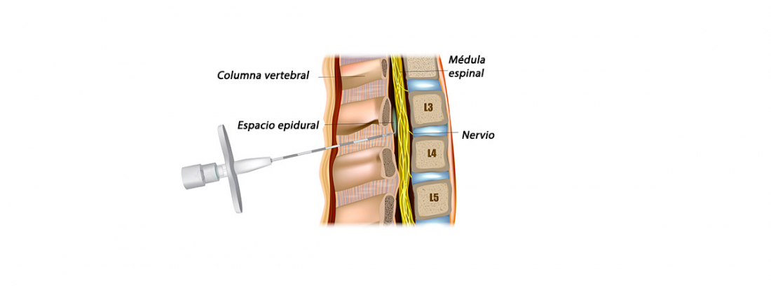 Cu Ndo Se Utiliza La Anestesia Epidural Canalsalud