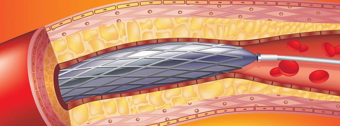 Angioplastia con balón para que sirve canalSALUD