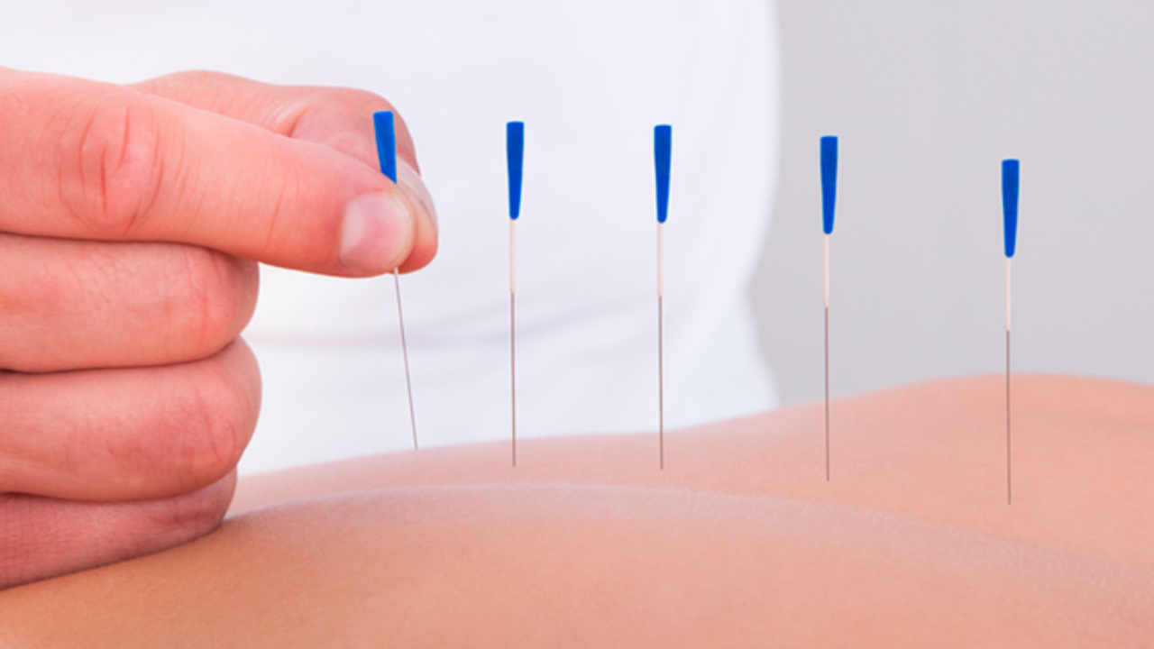 La acupuntura: terapia corporal alternativa -canalSALUD