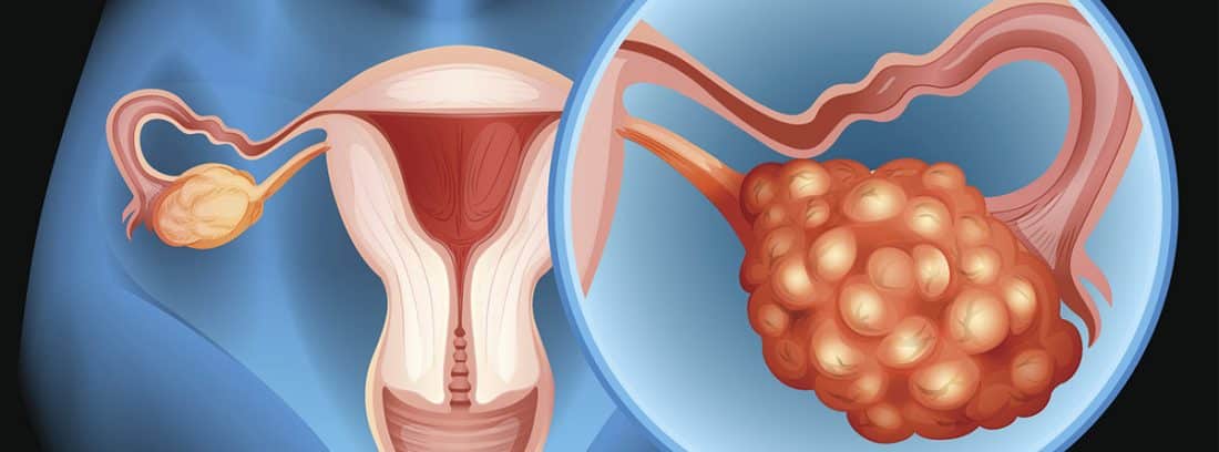 Cáncer De Ovario Síntomas Y Causas Canalsalud 1741