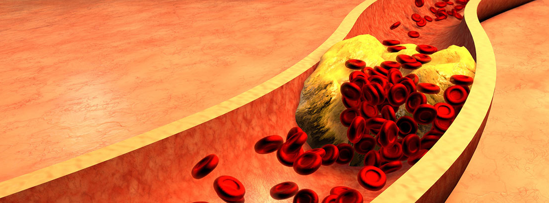 Aterosclerosis, Síntomas Y Tratamiento -canalSALUD