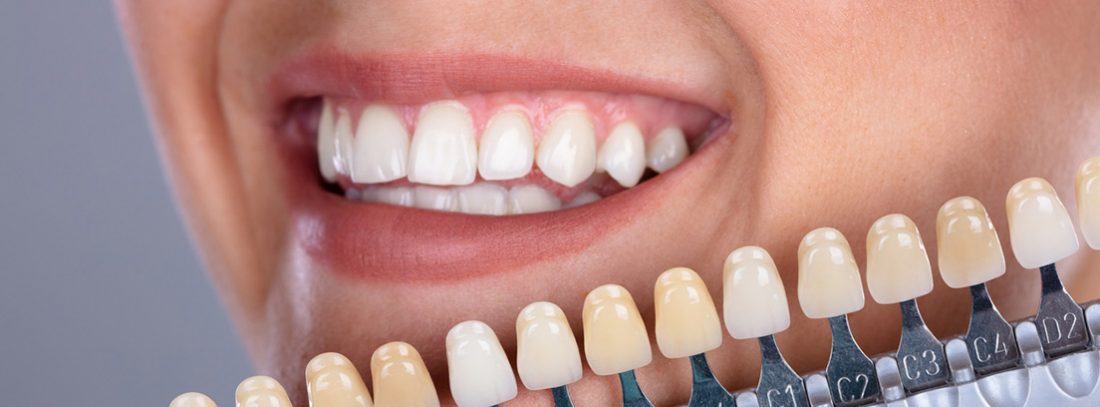 Carillas dentales: precio, materiales, consejos y alternativas