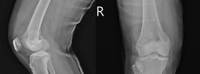 Sarcoma De Ewing: Síntomas Y Tratamiento -canalSALUD