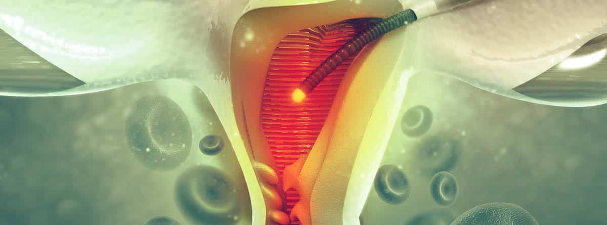 aparato reproductor femenino, atrofia vulvovaginal