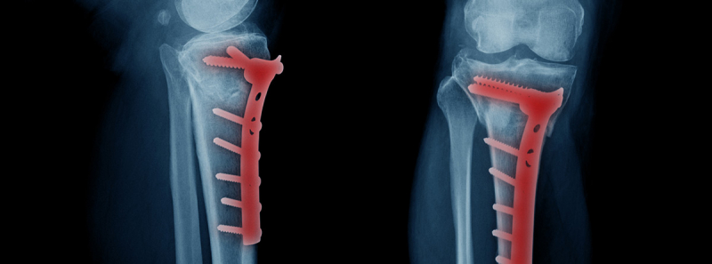 Osteosíntesis: Tipos, Materiales Y Más -canalSALUD