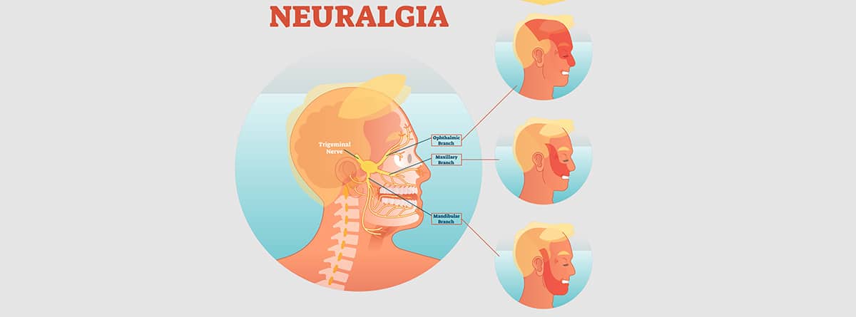 anatomía de sección transversal médica de neuralgia del trigémino con red neuronal facial y áreas de dolor. 