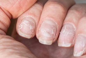 ¿Qué indican las estrías, rayas o cambio de color en las uñas?: uñas con escamas, enfermas