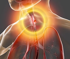 Causas y factores de riesgo del cáncer de esófago: imágen de patología en el esófago