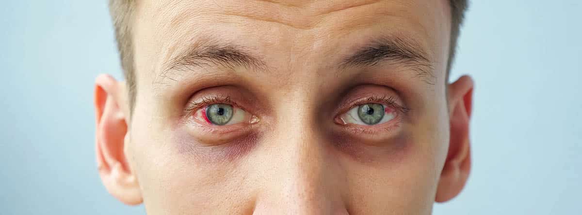 Enfermedad de Behcet: cara de hombre con uveítis en los ojos