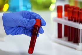 CHCM alta o baja, ¿qué significa? : Bioquímico revisando la reacción del suero sanguíneo en la muestra
