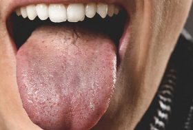 Puntos rojos en la lengua: hombre con la lengua fuera llena de puntos rojos