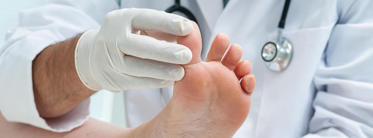 médico examinando la piel de un pie con dermatomicosis