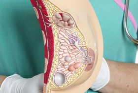 La imagen muestra patologías comunes, adenocarcinoma, carcinoma escirro infiltrante, quistes y fibroadenoma.