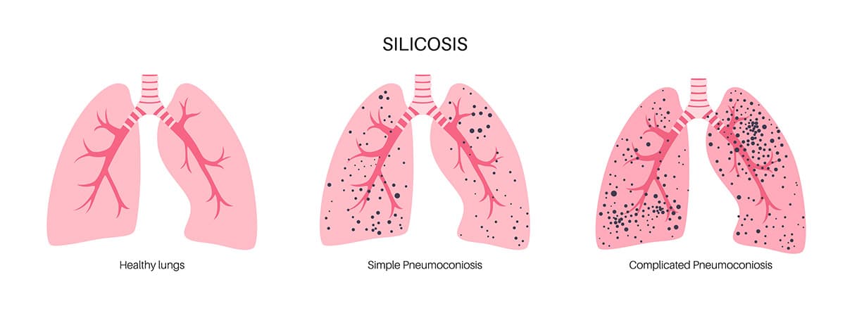 Ilustración de pulmones sanos vs pulmones dañados por silicosis