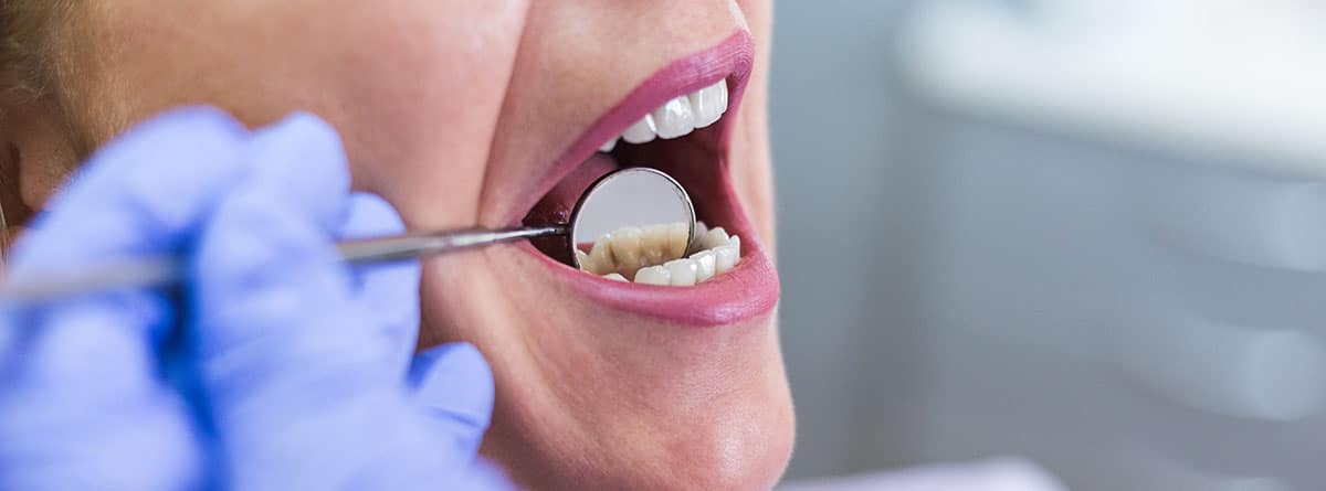 Boca de mujer con un espejo dental dentro para ver posibles heridas en el paladar