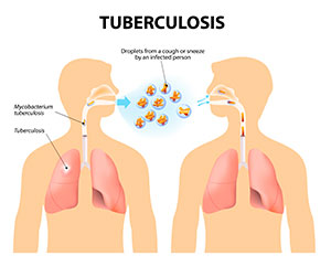 Resultado de imagen para imagenes tuberculosis pulmonar